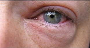 نصائح لعلاج انتفاخ الجفنين تحت العين